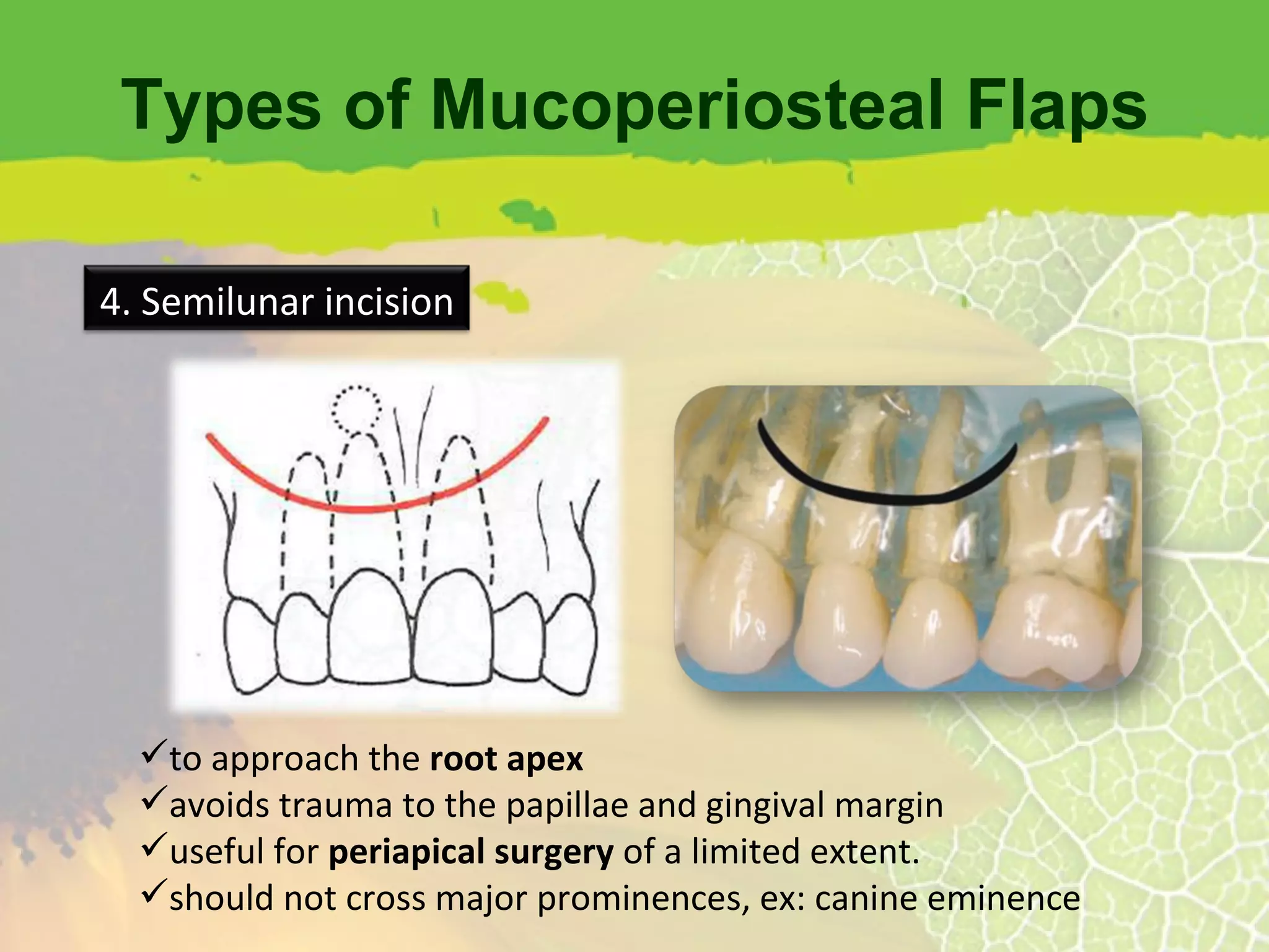 Types of Mucoperiosteal Flaps to approach the  root apex avoids trauma to the papillae and gingival margin useful for  periapical surgery  of a limited extent. should not cross major prominences, ex: canine eminence 4. Semilunar incision 