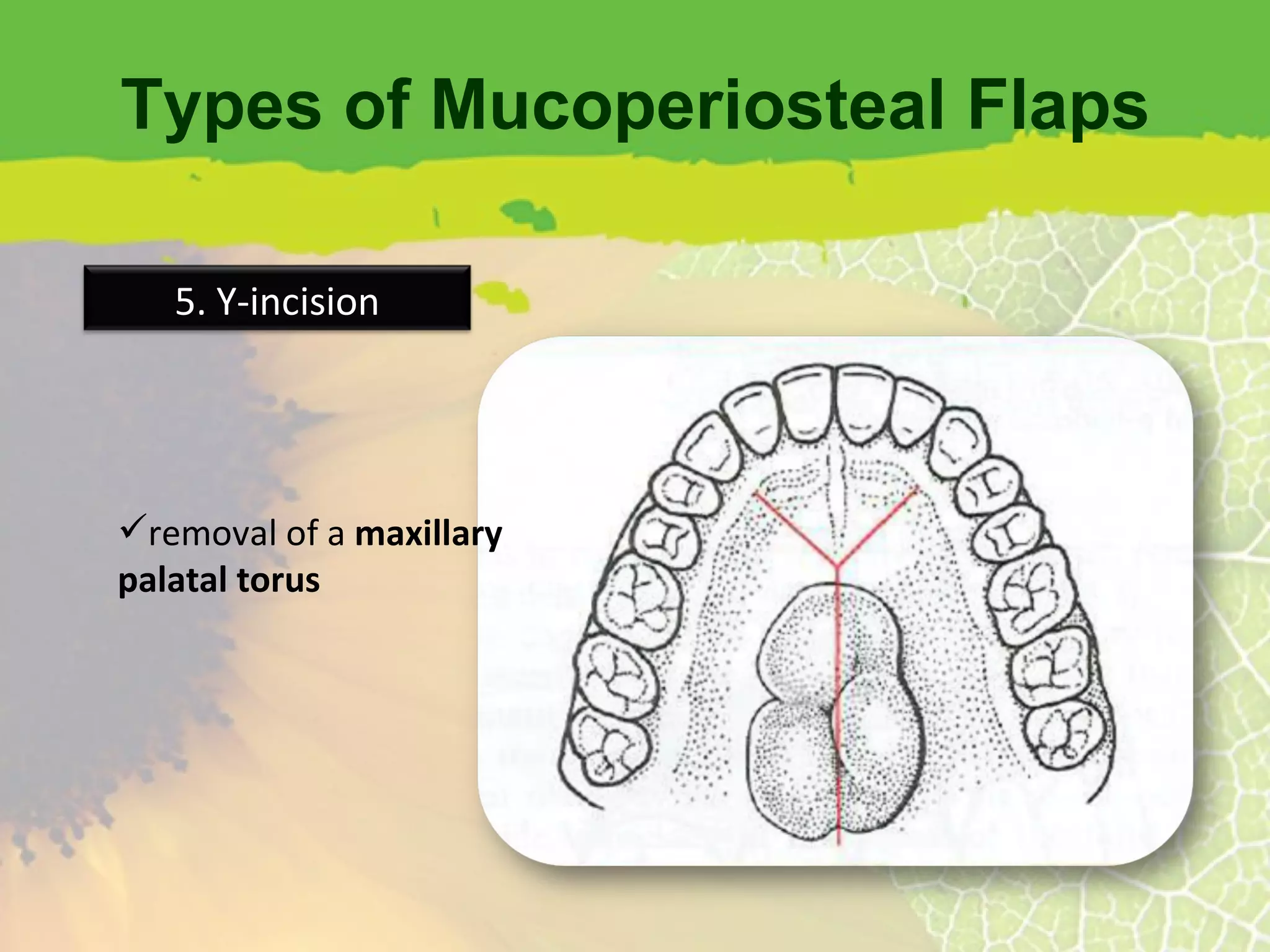 Types of Mucoperiosteal Flaps removal of a  maxillary palatal torus 5. Y-incision 