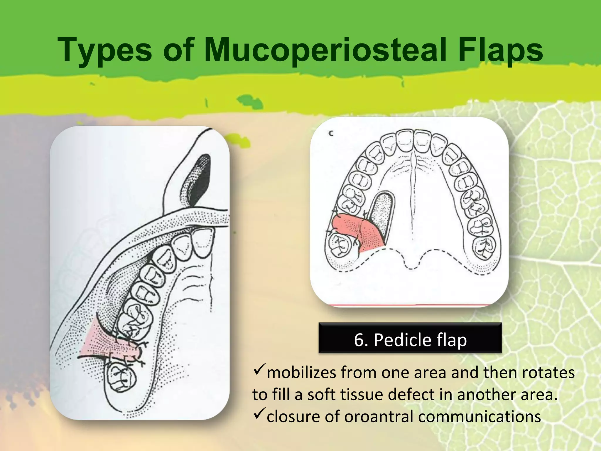 Types of Mucoperiosteal Flaps mobilizes from one area and then rotates to fill a soft tissue defect in another area. closure of oroantral communications 6. Pedicle flap 