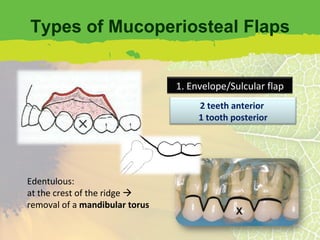 Types of Mucoperiosteal Flaps Edentulous: at the crest of the ridge   removal of a  mandibular torus 2 teeth anterior  1 tooth posterior 1. Envelope/Sulcular flap 