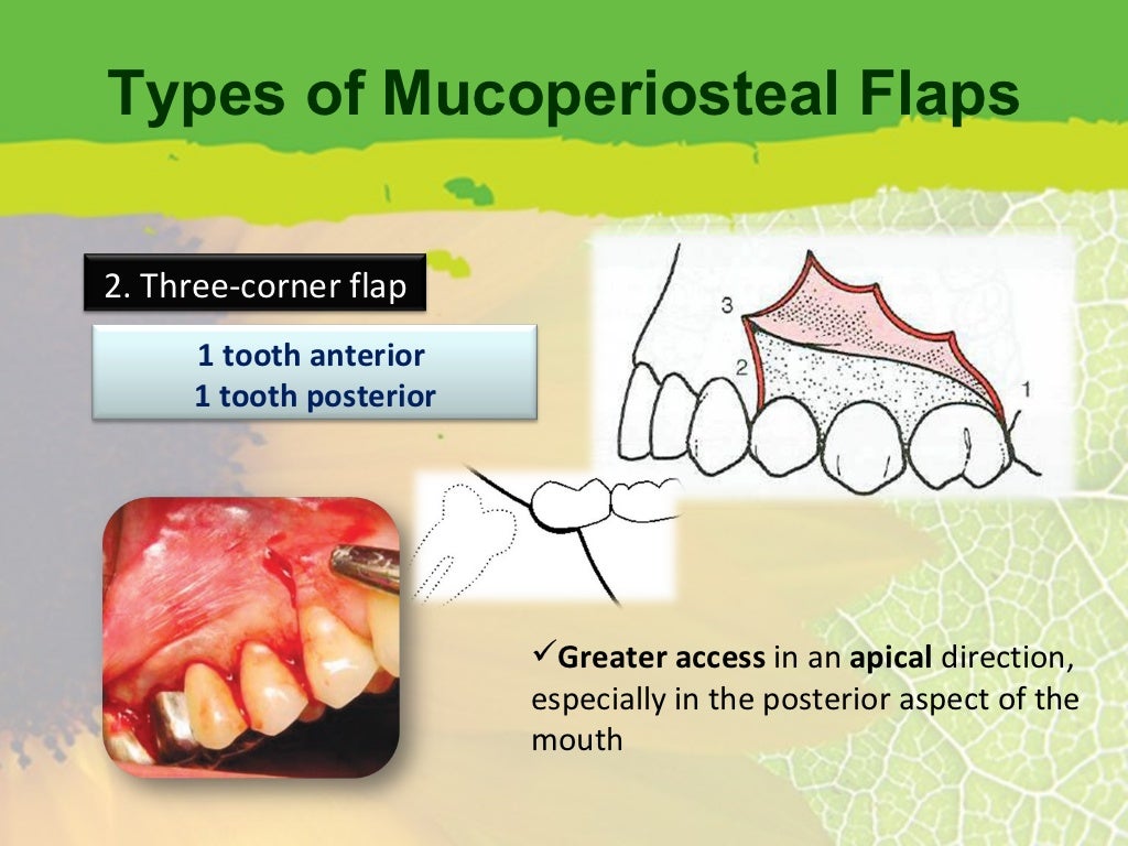 Flap Design for Minor Oral Surgery