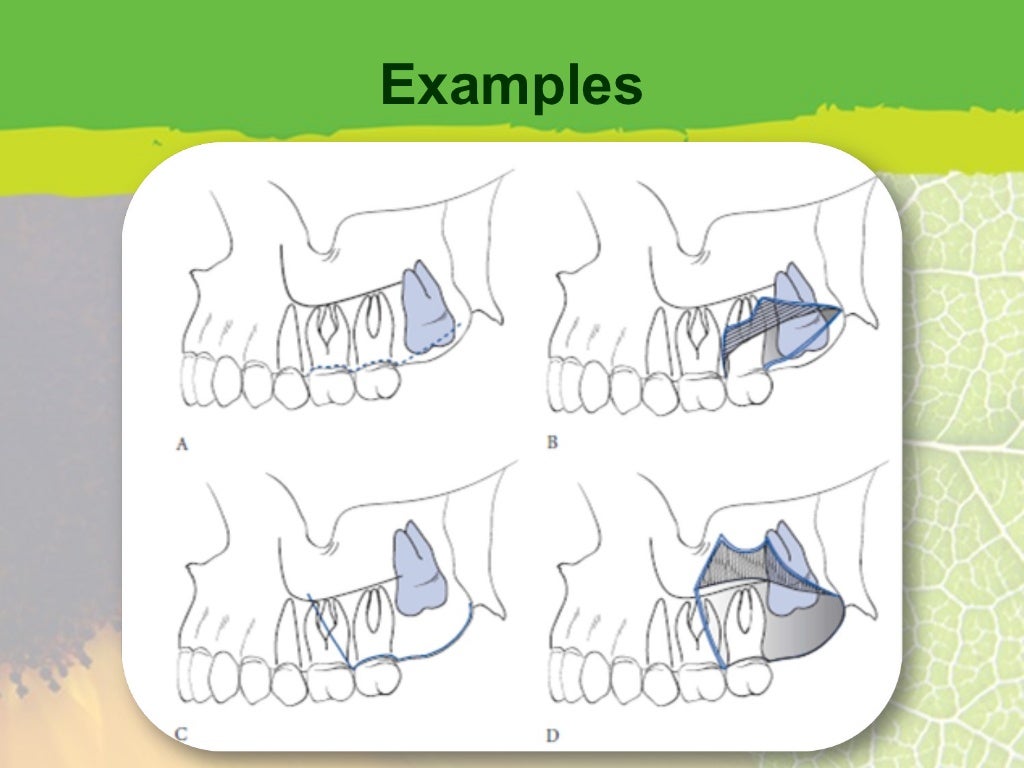 Flap Design for Minor Oral Surgery