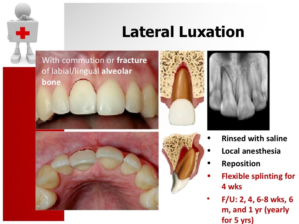 Traumatic Dental Injury and Treatment