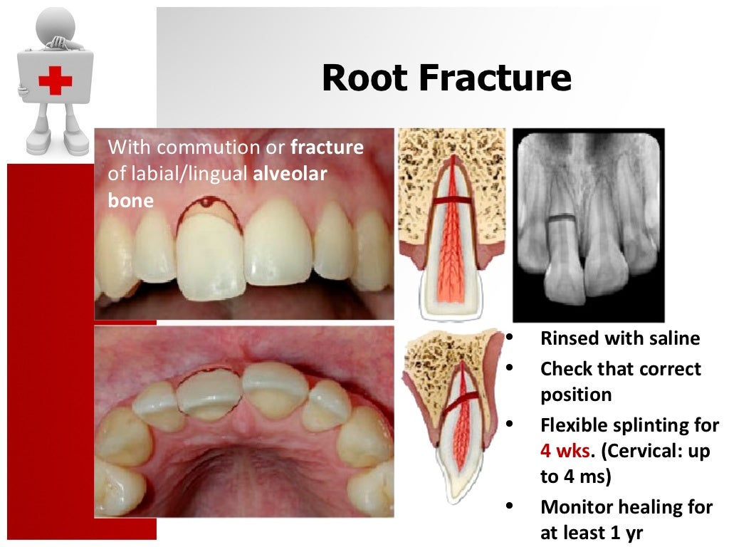 Traumatic Dental Injury and Treatment