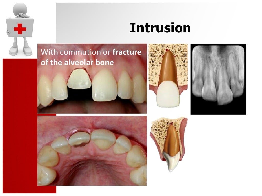 Traumatic Dental Injury and Treatment
