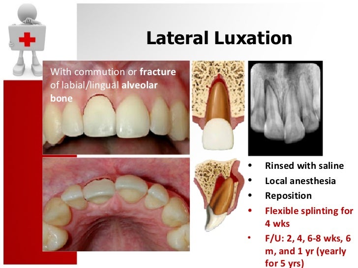 tooth luxation