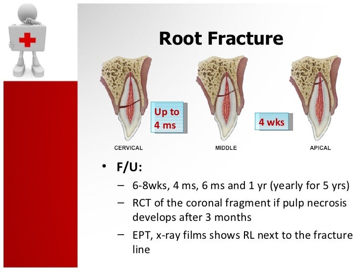 Vertical Root Fracture Treatment