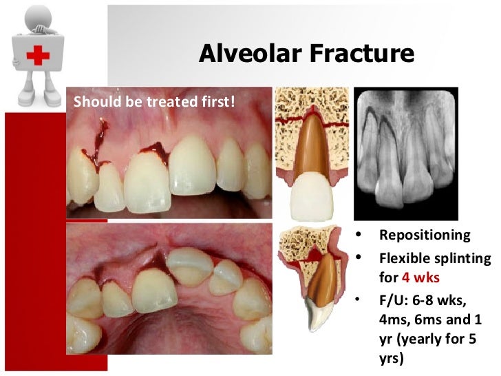 Tooth Alveolar Fracture