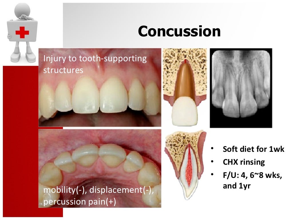 Traumatic Dental Injury and Treatment