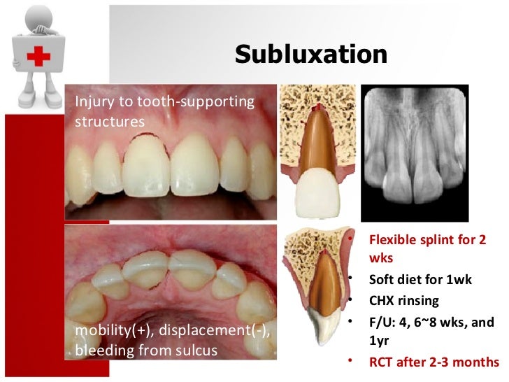 traumatic dental injury and treatment tooth luxation