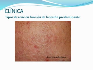 CLÍNICA
Tipos de acné en función de la lesión predominante
Acné comedoniano
 