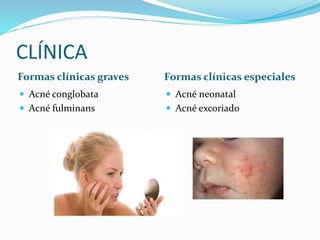 CLÍNICA
Formas clínicas graves Formas clínicas especiales
 Acné conglobata
 Acné fulminans
 Acné neonatal
 Acné excoriado
 