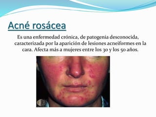 Acné rosácea
Es una enfermedad crónica, de patogenia desconocida,
caracterizada por la aparición de lesiones acneiformes en la
cara. Afecta más a mujeres entre los 30 y los 50 años.
 