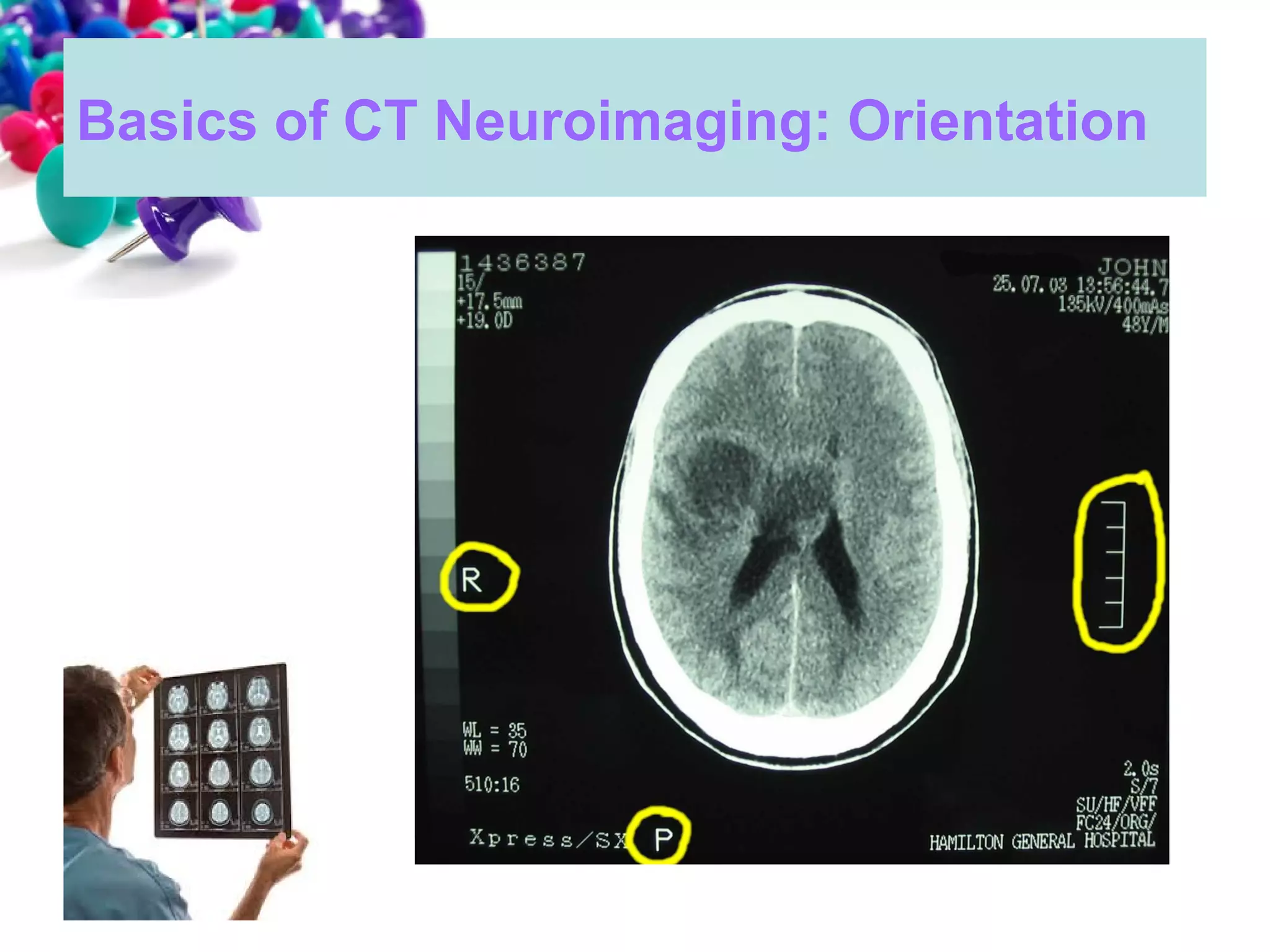 101 ct neuroimaging | PPT
