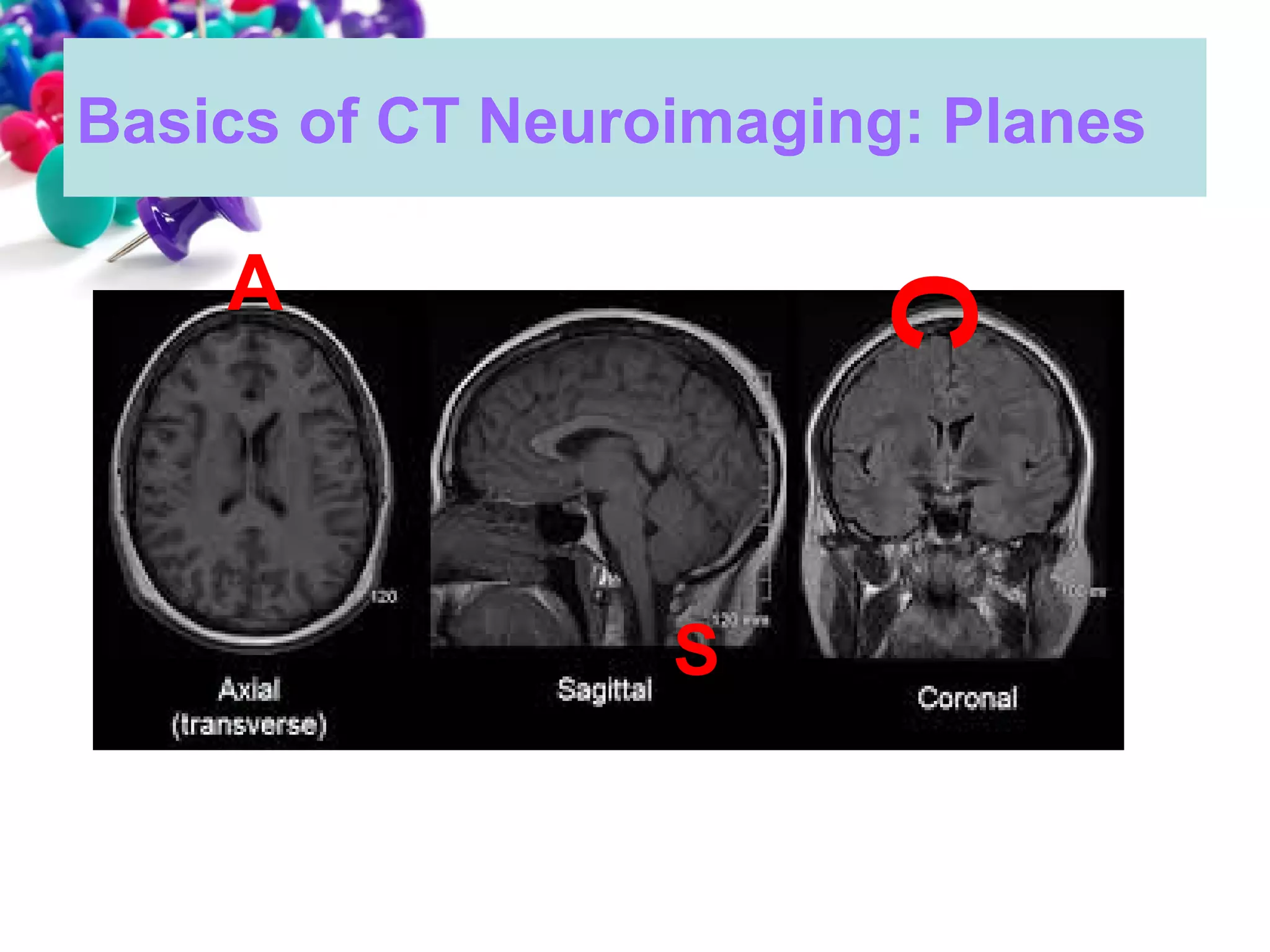 101 ct neuroimaging | PPT