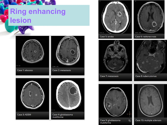 101 ct neuroimaging | PPT | Brain and Nervous System Disorders ...