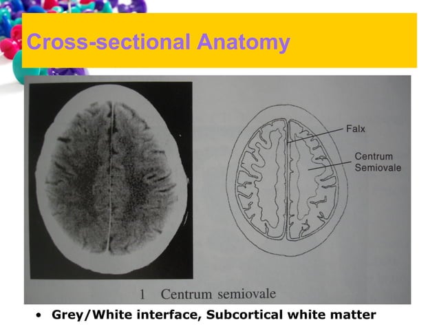 101 ct neuroimaging | PPT | Brain and Nervous System Disorders ...