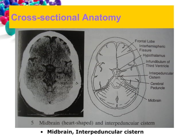 101 ct neuroimaging | PPT | Brain and Nervous System Disorders ...