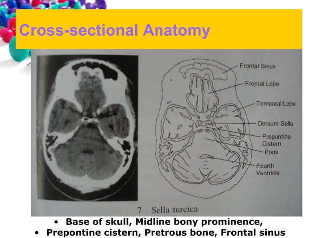 101 ct neuroimaging | PPT | Brain and Nervous System Disorders ...