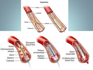 pbs-peripheral-vascular-dieases-in-humans-pdf