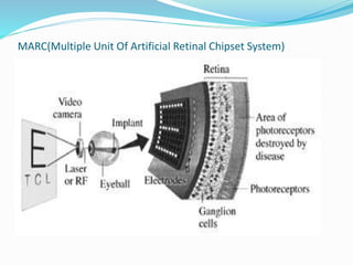 MARC(Multiple Unit Of Artificial Retinal Chipset System)
 