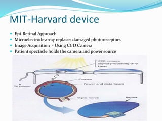 MIT-Harvard device
 Epi-Retinal Approach
 Microelectrode array replaces damaged photoreceptors
 Image Acquisition - Using CCD Camera
 Patient spectacle holds the camera and power source
 