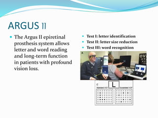 ARGUS II
 The Argus II epiretinal
prosthesis system allows
letter and word reading
and long-term function
in patients with profound
vision loss.
 Test I: letter identification
 Test II: letter size reduction
 Test III: word recognition
 