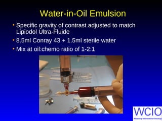 Water-in-Oil Emulsion
• Specific gravity of contrast adjusted to match
Lipiodol Ultra-Fluide
• 8.5ml Conray 43 + 1.5ml sterile water
• Mix at oil:chemo ratio of 1-2:1
 