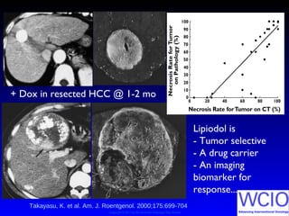 Copyright © 2011 by the American Roentgen Ray Society
Takayasu, K. et al. Am. J. Roentgenol. 2000;175:699-704
Lipiodol is
- Tumor selective
- A drug carrier
- An imaging
biomarker for
response...
+ Dox in resected HCC @ 1-2 mo
 