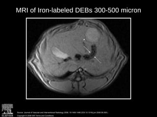 MRI of Iron-labeled DEBs 300-500 micron
Source: Journal of Vascular and Interventional Radiology 2008; 19:1490-1496 (DOI:10.1016/j.jvir.2008.06.008 )
Copyright © 2008 SIR Terms and Conditions
 