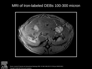 MRI of Iron-labeled DEBs 100-300 micron
Source: Journal of Vascular and Interventional Radiology 2008; 19:1490-1496 (DOI:10.1016/j.jvir.2008.06.008 )
Copyright © 2008 SIR Terms and Conditions
 