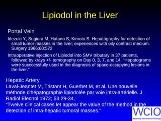 Lipiodol in the LiverLipiodol in the Liver
Portal VeinPortal Vein
Idezuki Y, Sugiura M, Hatano S, Kimoto S. Hepatography for detection of
small tumor masses in the liver; experiences with oily contrast medium.
Surgery 1966;60:572
Intraoperative injection of Lipiodol into SMV tributary in 37 patients,
followed by xrays +/- tomography on Day 0, 3, 7, and 14. “Hepatograms
were succcessfully used in the diagnosis of space-occupying lesions in
the liver.”
Hepatic Artery
Laval-Jeantet M, Tristant H, Guerbet M, et al. Une nouvelle
méthode d'hépatographie lipiodolée par voie intra-artérielle. J
Radiol Electrol 1972; 53:29-34.
“Twelve clinical cases let appear the value of the method in the
detection of intra-hepatic tumoral masses.”
 