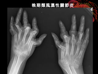 晚期類風濕性關節炎 
 