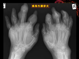痛風性關節炎
 