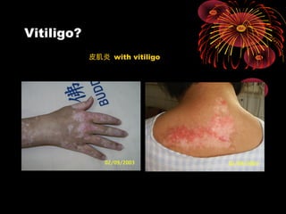 Vitiligo? 
皮肌炎 with vitiligo 
 