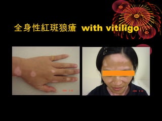 全身性紅斑狼瘡 with vitiligo 
 