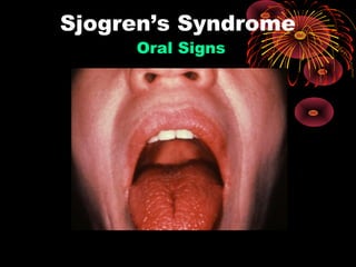 Sjogren’s Syndrome 
Oral Signs 
Slide reprinted from the Clinical Slide Collection on the 
 