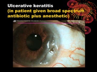 Ulcerative keratitis 
(in patient given broad spectrum 
antibiotic plus anesthetic) 
 