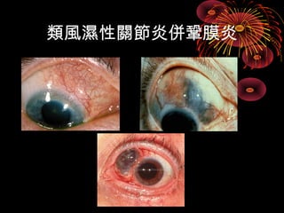 類風濕性關節炎併鞏膜炎 
 