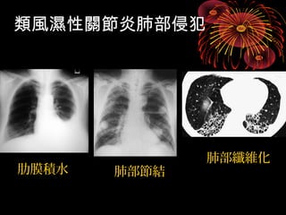 類風濕性關節炎肺部侵犯 
肋膜積水肺部節結 
肺部纖維化 
 