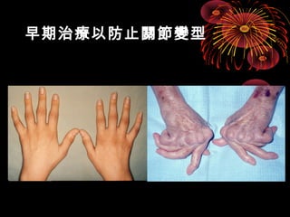 早期治療以防止關節變型 
 