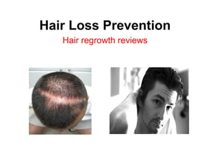 Hair Loss Prevention  Hair regrowth reviews 