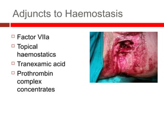 Adjuncts to Haemostasis
 Factor VIIa
 Topical
haemostatics
 Tranexamic acid
 Prothrombin
complex
concentrates
 