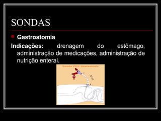SONDAS
 Gastrostomia
Indicações: drenagem do estômago,
administração de medicações, administração de
nutrição enteral.
 