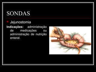SONDAS
 Jejunostomia
Indicações: administração
de medicações ou
administração de nutrição
enteral.
 