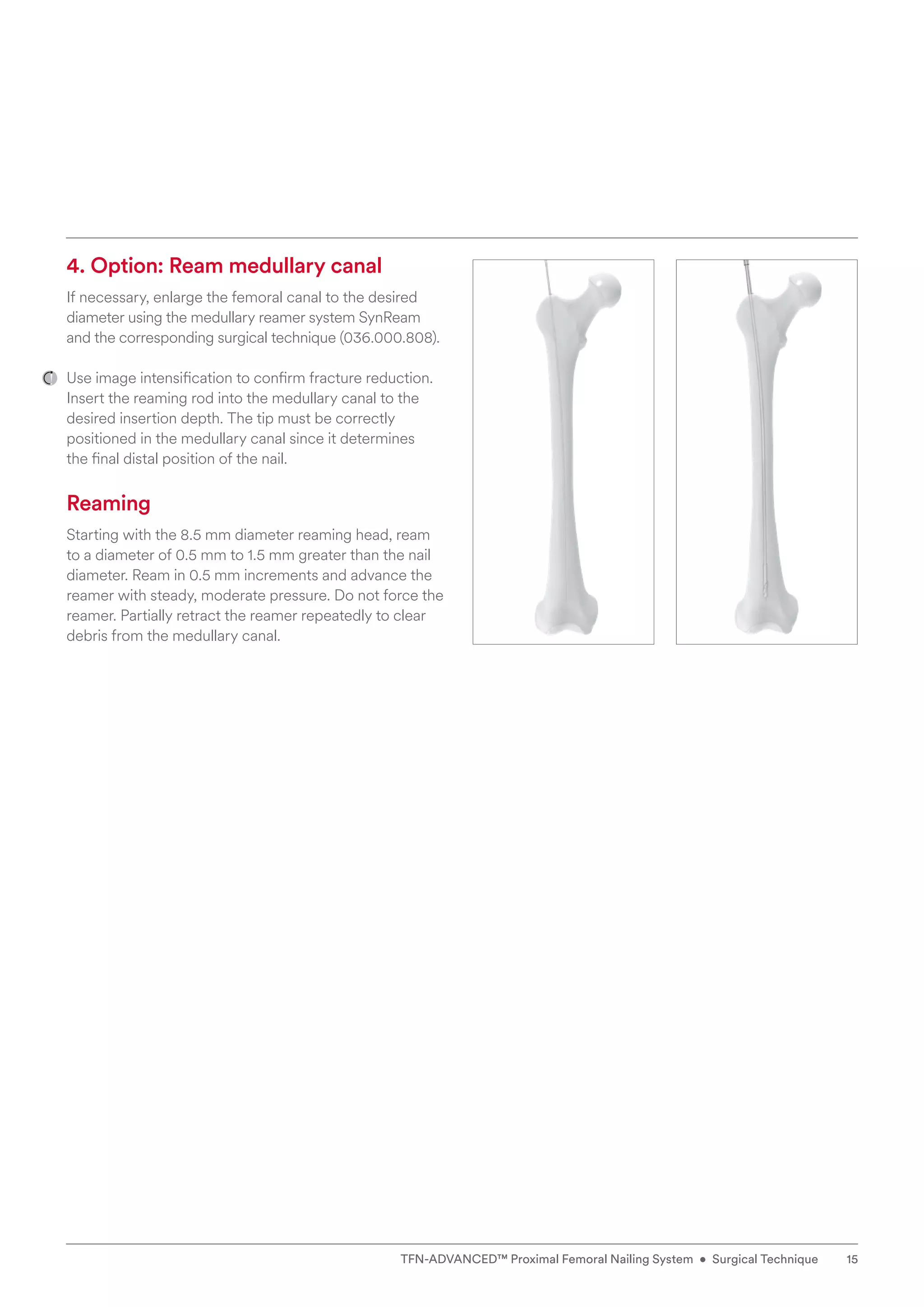 4. Option: Ream medullary canal
If necessary, enlarge the femoral canal to the desired
diameter using the medullary reamer system SynReam
and the corresponding surgical technique (036.000.808).
Use image intensification to confirm fracture reduction.
Insert the reaming rod into the medullary canal to the
desired insertion depth. The tip must be correctly
positioned in the medullary canal since it determines
the final distal position of the nail.
Reaming
Starting with the 8.5 mm diameter reaming head, ream ­
to a diameter of 0.5 mm to 1.5 mm greater than the nail
diameter. Ream in 0.5 mm increments and advance the
reamer with steady, moderate pressure. Do not force the
reamer. Partially retract the reamer repeatedly to clear
debris from the medullary canal.
15
TFN-ADVANCED™ Proximal Femoral Nailing System • Surgical Technique
 