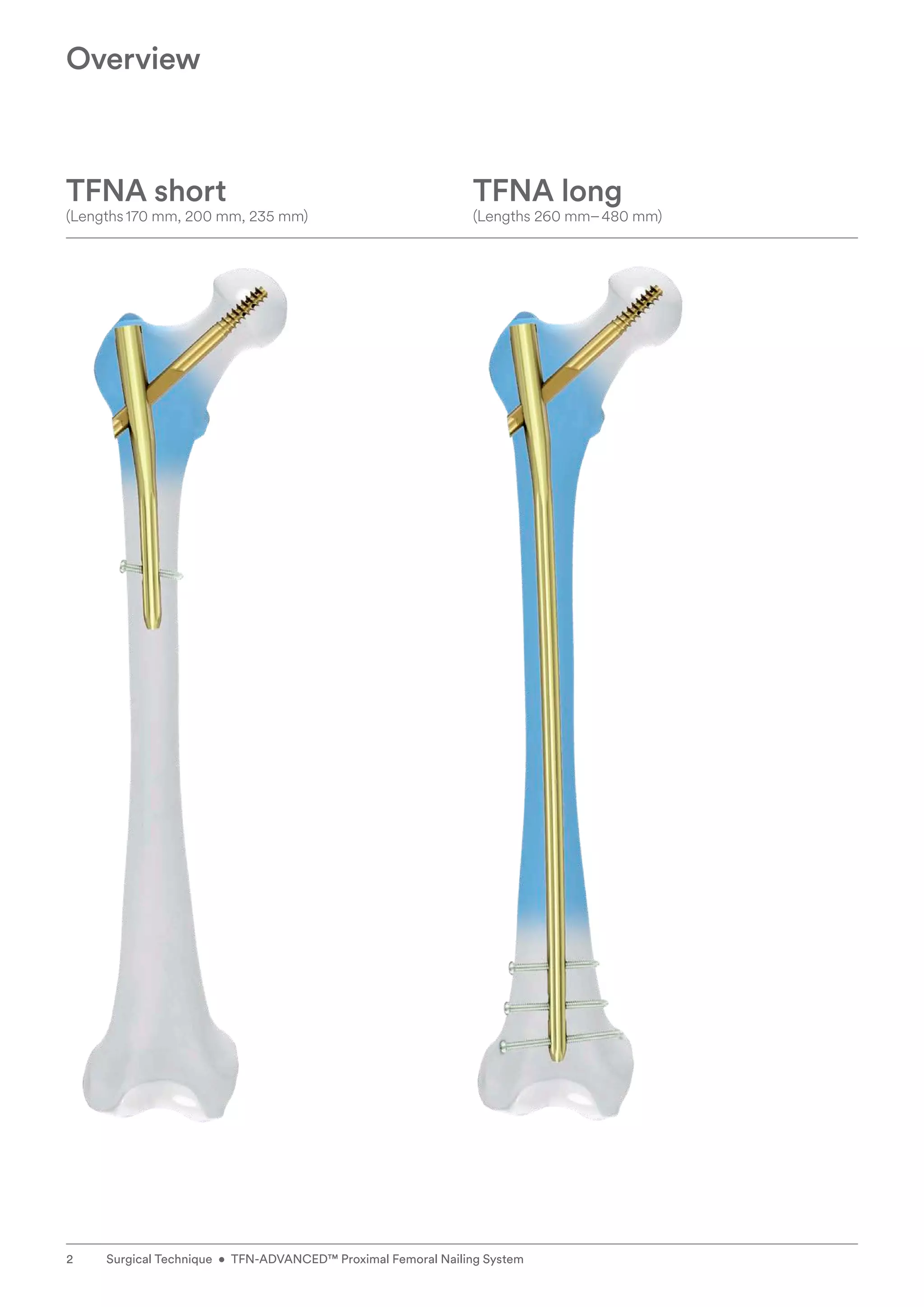 Overview
TFNA short
(Lengths170 mm, 200 mm, 235 mm)
TFNA long
(Lengths 260 mm–480 mm)
2 Surgical Technique • TFN-ADVANCED™ Proximal Femoral Nailing System
 