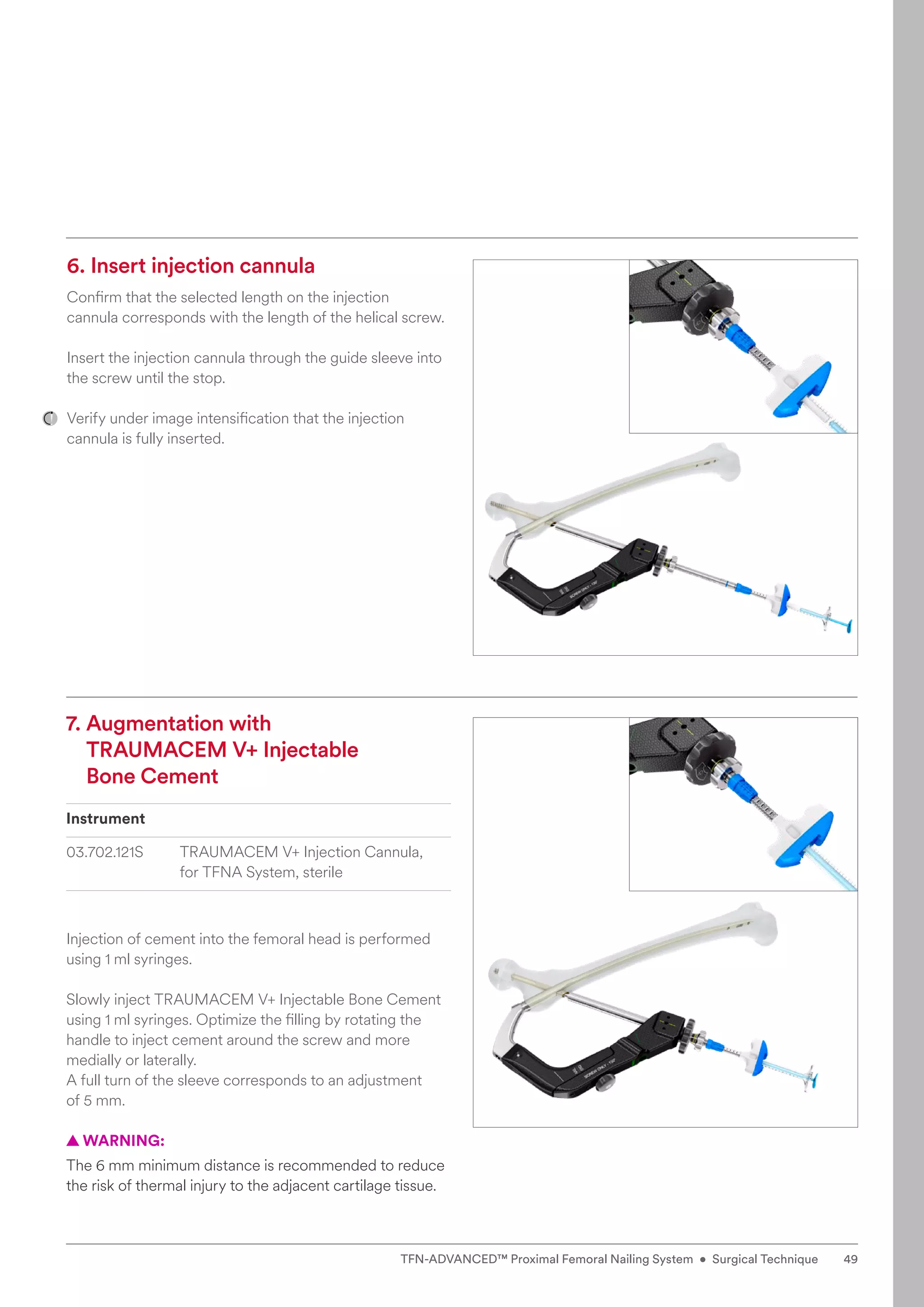 6. Insert injection cannula
Confirm that the selected length on the injection
cannula corresponds with the length of the helical screw.
Insert the injection cannula through the guide sleeve into
the screw until the stop.
Verify under image intensification that the injection
­
cannula is fully inserted.
7. 
Augmentation with
TRAUMACEM V+ Injectable
Bone Cement
Instrument
03.702.121S TRAUMACEM V+ Injection Cannula,
for TFNA System, sterile
Injection of cement into the femoral head is performed
using 1 ml syringes.
Slowly inject TRAUMACEM V+ Injectable Bone Cement
­
using 1 ml syringes. Optimize the filling by rotating the
handle to inject cement around the screw and more
­
medially or laterally.
A full turn of the sleeve corresponds to an adjustment
of 5 mm.
  
▲ WARNING:
The 6 mm minimum distance is recommended to reduce
the risk of thermal injury to the adjacent cartilage tissue.
49
TFN-ADVANCED™ Proximal Femoral Nailing System • Surgical Technique
 
