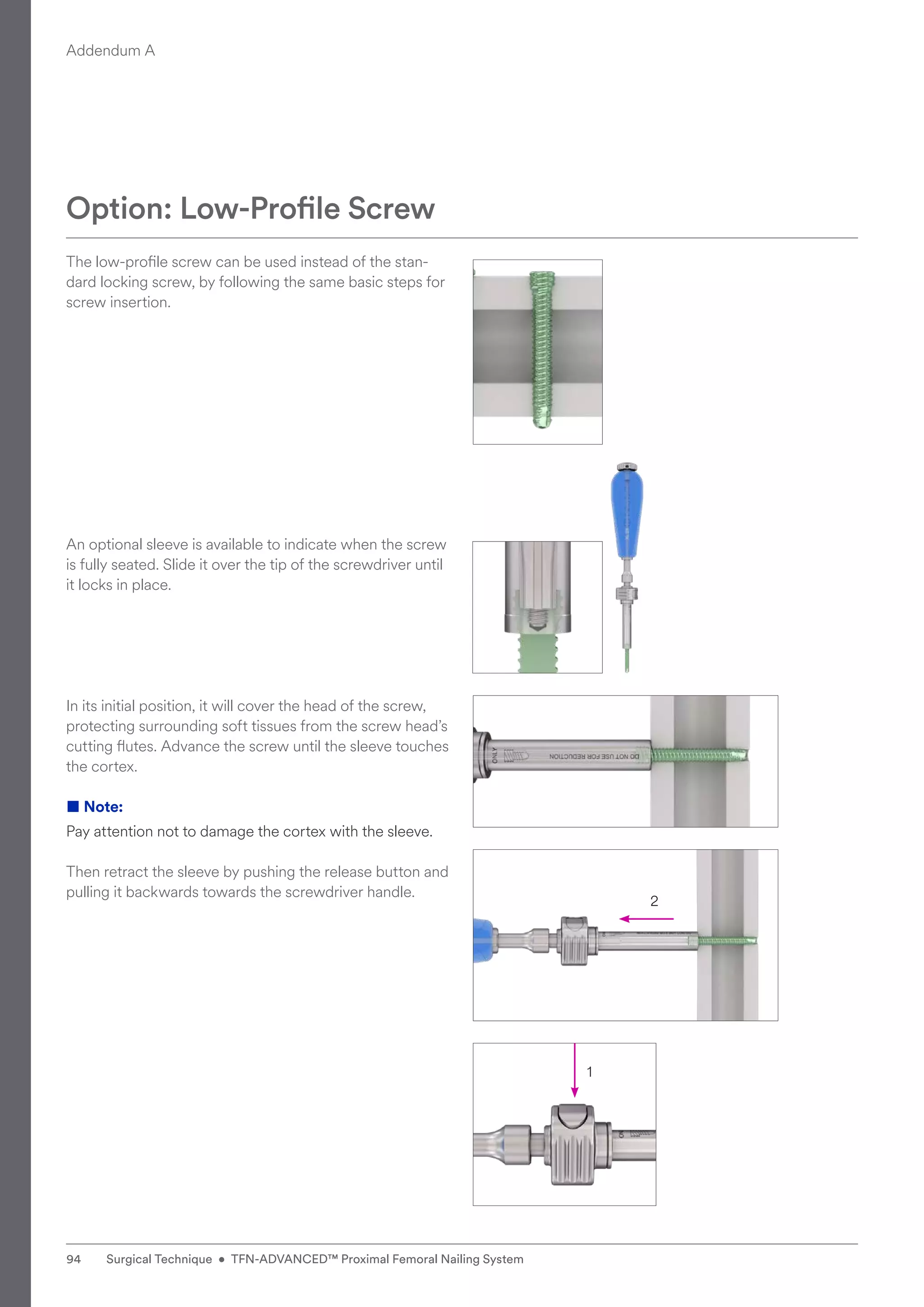 1
2
The low-profile screw can be used instead of the stan-
dard locking screw, by following the same basic steps for
screw insertion.
An optional sleeve is available to indicate when the screw
is fully seated. Slide it over the tip of the screwdriver until
it locks in place.
In its initial position, it will cover the head of the screw,
protecting surrounding soft tissues from the screw head’s
cutting flutes. Advance the screw until the sleeve touches
the cortex.
■ Note:
Pay attention not to damage the cortex with the sleeve.
Then retract the sleeve by pushing the release button and
pulling it backwards towards the screwdriver handle.
Option: Low-Profile Screw
Addendum A
94 Surgical Technique • TFN-ADVANCED™ Proximal Femoral Nailing System
 