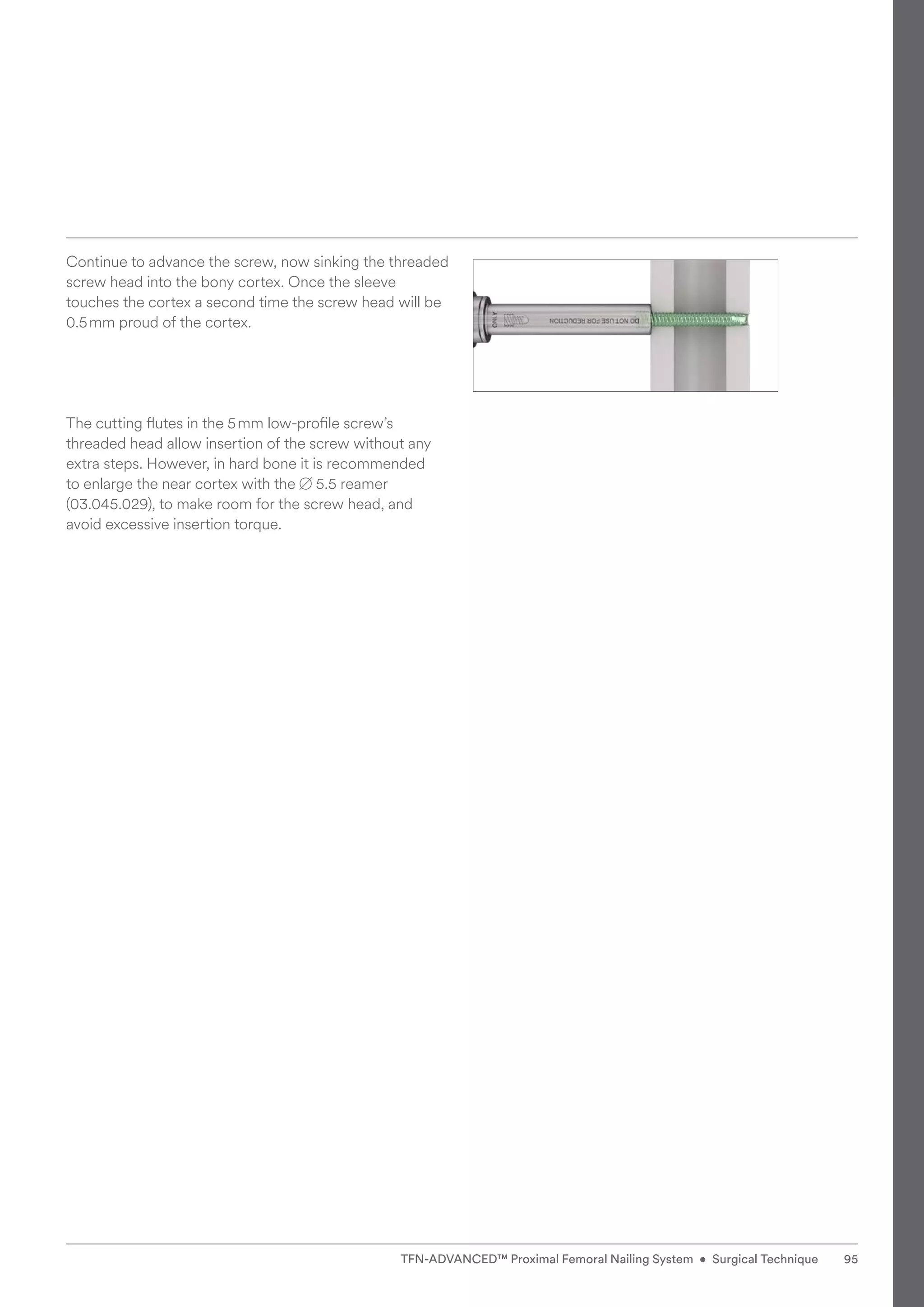 Continue to advance the screw, now sinking the threaded
screw head into the bony cortex. Once the sleeve
touches the cortex a second time the screw head will be
0.5mm proud of the cortex.
The cutting flutes in the 5mm low-profile screw’s
threaded head allow insertion of the screw without any
extra steps. However, in hard bone it is recommended ­
to enlarge the near cortex with the B 5.5 reamer
(03.045.029), to make room for the screw head, and
avoid excessive insertion torque.
95
TFN-ADVANCED™ Proximal Femoral Nailing System • Surgical Technique
 